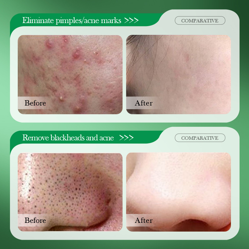 Salicylic Acid Acne Treatment  - Salicylic Acid Blackhead Remover ulasan dan harga